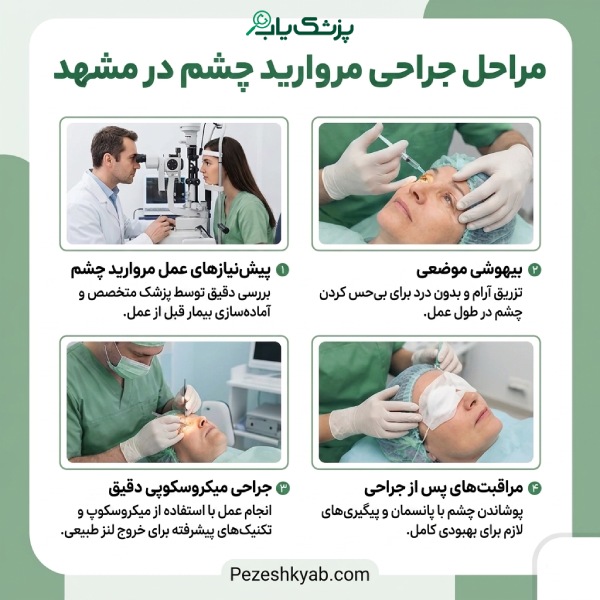 مراحل جراحی آب مروارید چشم در مشهد