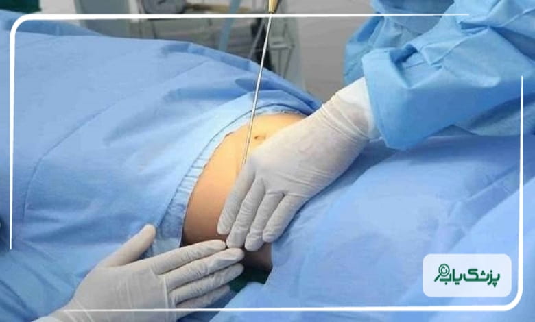 معیارهای انتخاب جراح متخصص لیپوماتیک در اصفهان