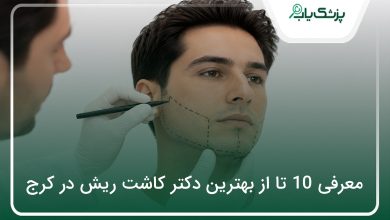 بهترین دکتر کاشت ریش در کرج