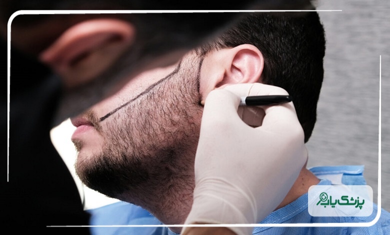کاشت ریش تخصصی توسط بهترین متخصصان در مشهد