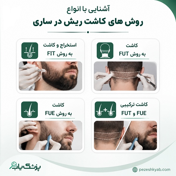 آشنایی با انواع روش های کاشت ریش در ساری