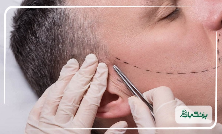 کاشت ریش حرفهای توسط بهترین دکترهای ساری