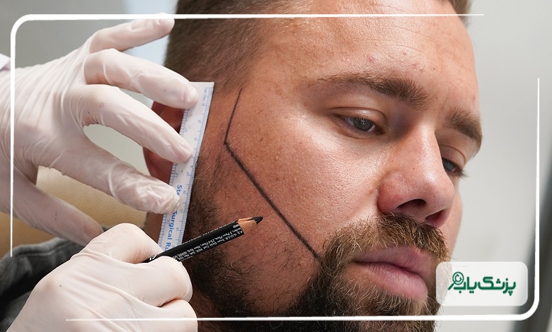 کاشت ریش حرفهای توسط بهترین متخصصان در شیراز