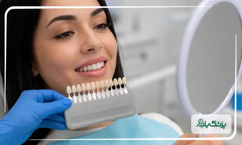 تفاوت انجام بلیچینگ دندان در مطب و منزل چیست؟