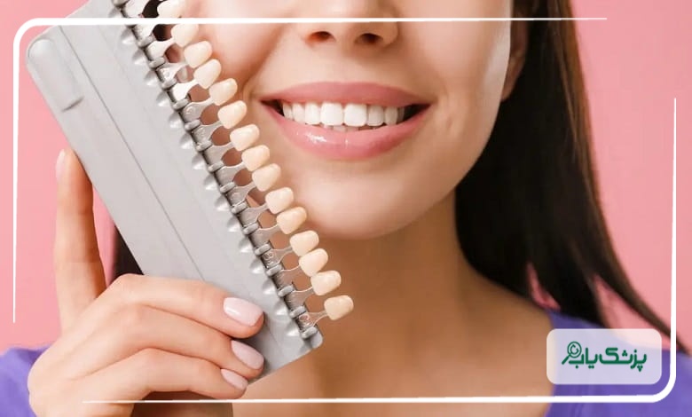 کامپوزیت دندان بهتر است یا لمینت سرامیکی؟