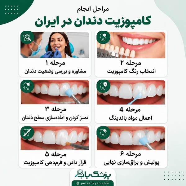مراحل کامپوزیت دندان در ایران