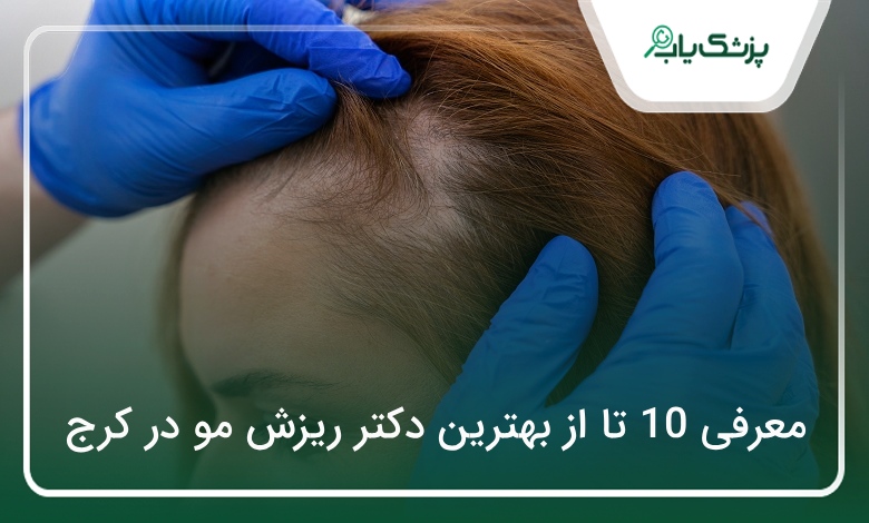 بهترین دکتر ریزش مو در کرج