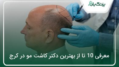 بهترین دکتر کاشت مو در کرج