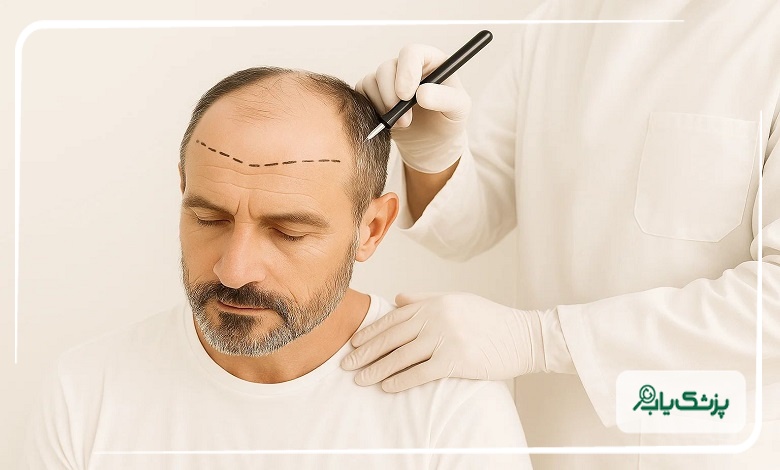 کاشت موی حرفهای توسط بهترین متخصصان در ساری