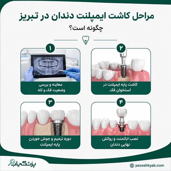 مراحل کاشت ایمپلنت دندان در تبریز چگونه است؟