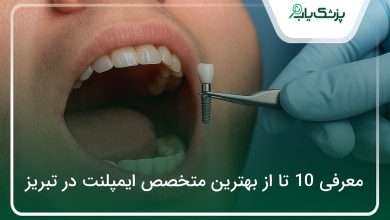 بهترین متخصص ایمپلنت در تبریز