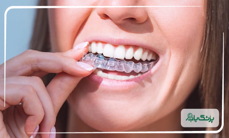 تفاوت ارتودنسی ثابت و متحرک؛ کدام یک سریعتر جواب میدهد؟
