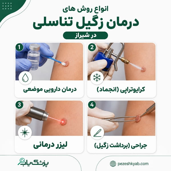 انواع روش های درمان زگیل تناسلی در شیراز