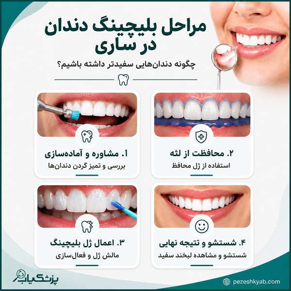 مراحل بلیچینگ دندان در ساری