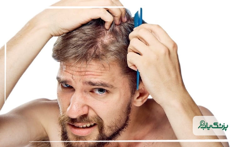 چه افرادی بهترین گزینه برای مراجعه به بهترین دکتر ریزش مو در ایران هستند؟