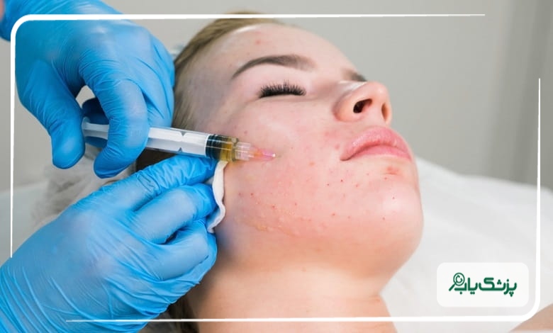 تاثیر مزوتراپی زیر چشم برای تیرگی و پف چشم