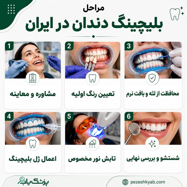 مراحل بلیچینگ دندان در ایران