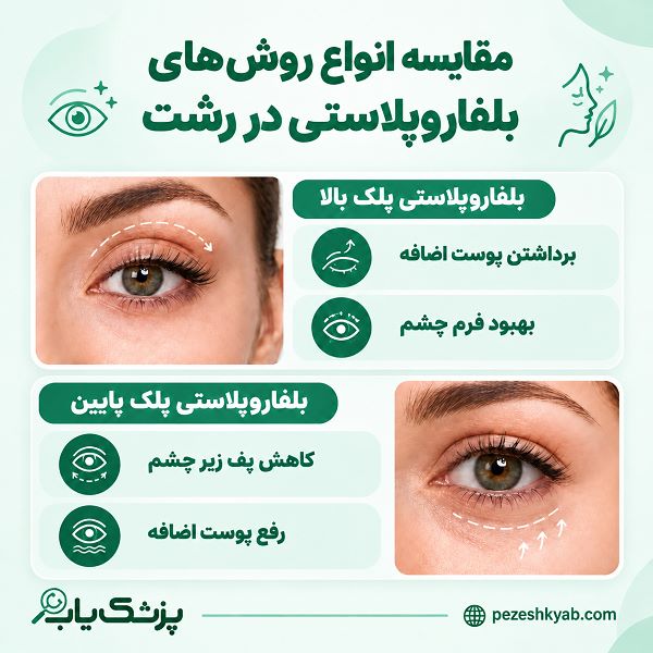 مقایسه انواع روش های بلفاروپلاستی در رشت